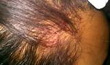 How Can I Treat Psoriasis On My Scalp Pictures