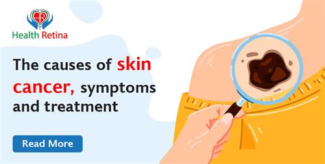 The Causes Of Skin Cancer Symptoms And Treatment Health Retina