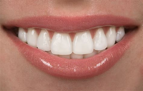 6 Impressive Benefits Of Veneers