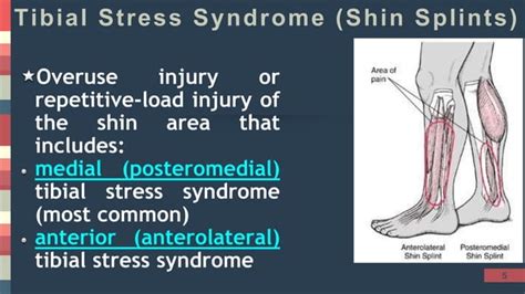Chronic Exertional Compartment Syndrome