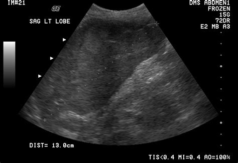 Normal Liver Size On Ultrasound Radrounds Radiology Network