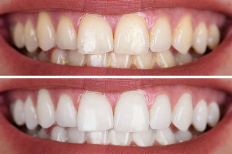 Teeth Whitening Cosmetic Dentistry Dental Hygiene