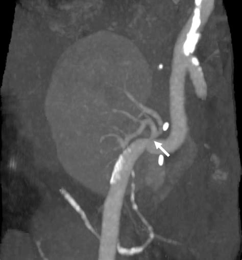 Ct Scan With Iodine Contrast Arterial Phase Showing A 50