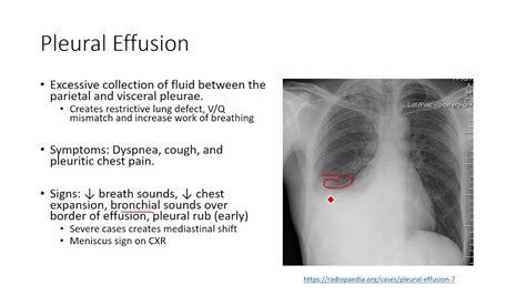 Acute Pulmonary Pathophysiology 2 Pleural Effusion Youtube