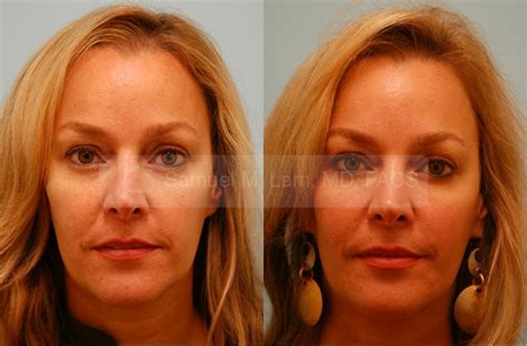 Dallas Injectable Fillers Before And After Photos Plano Plastic