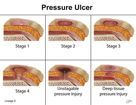 Decubitus Ulcers Stages Of Heel Decubitus Ulcer