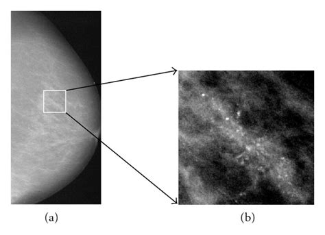 A Mammogram Image In Cc View A And Clustered Microcalcifications In