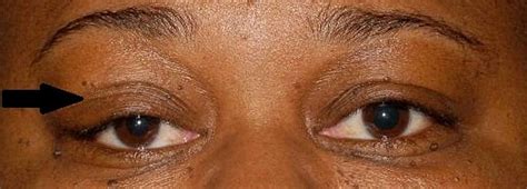 Cureus Primary Isolated Lacrimal Gland Amyloidosis A Case Report And