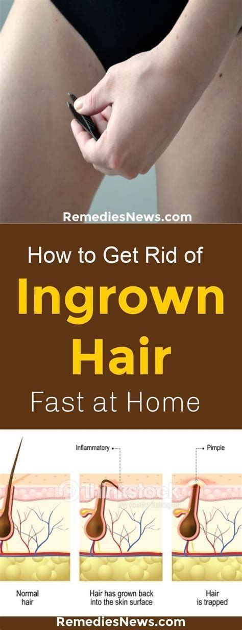Pin On How To Get Rid Of An Ingrown Hair