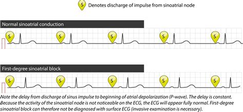 Sinoatrial Block Sa Block Ecg Criteria Causes And Clinical Features