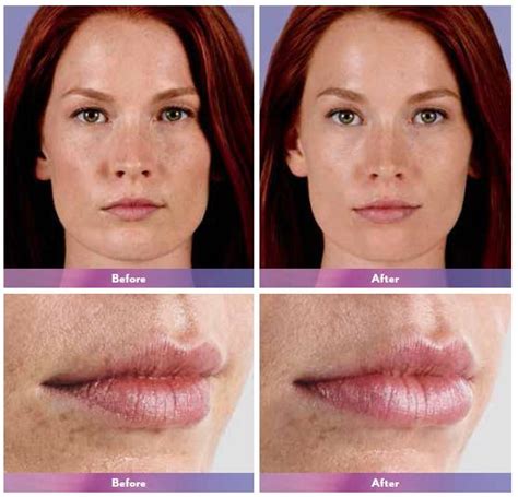 Juvederm Before And After Photos Juvederm Costs And Side Effects