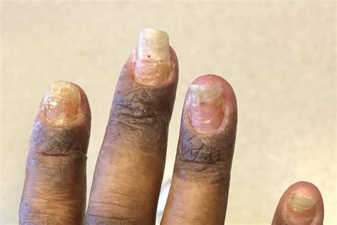 Inflammation And Redness Of The Fingernail Folds Clinical Advisor