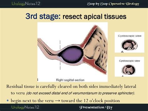 Turp Step By Step Operative Urology