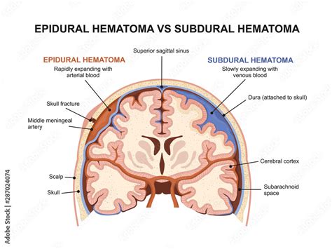 Epidural Hematoma Vs Subdural Hematoma Obrazy Fototapety Plakaty