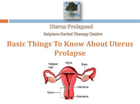 Ppt Learn About Some Fast Facts Of Uterine Prolapse Powerpoint My XXX
