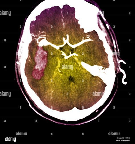 Computed Tomography Ct Scan Of The Brain Showing A Ruptured
