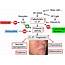 New Insights Into Rosacea Pathophysiology A Review Of Recent Findings 