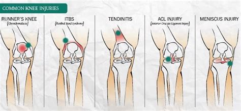 Knee Injuries In Sport Sydney Physio Group