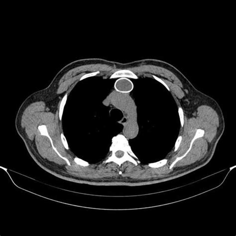 Jisho.org is lovingly crafted by kim, miwa and andrew. 胸腺囊肿【多图】_39医疗图集-39健康网