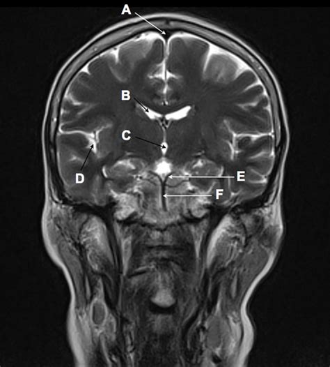 Coronal T2 Weighted Magnetic Resonance Image Of The Brain The Bmj