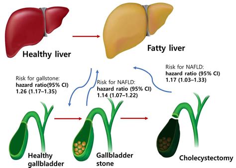 Liver Disease Gallstones