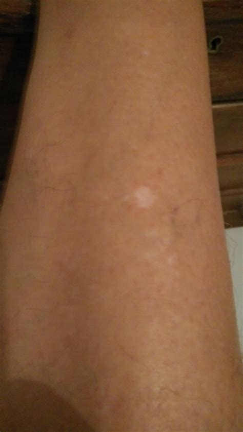 Small White Spots On Skin Naturalskins