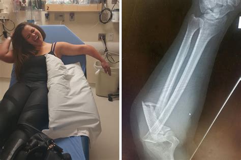 Drunk Girl Has Had So Much She Cant Tell How Broken Her Arm Is Daily Star