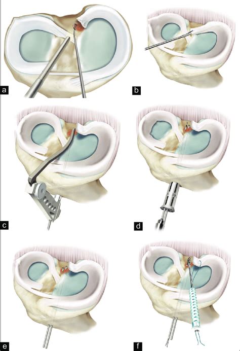 Illustration Of An Anatomic Two Tunnel Transtibial Medial Meniscus