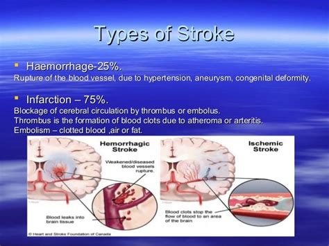 Stroke Cerebrovascular Accident Cva