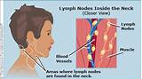 Lymph Nodes Sore On One Side Of Neck Images