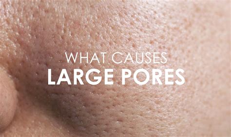 Enlarged Pores On The Face Causes And Symptoms Premier Clinic