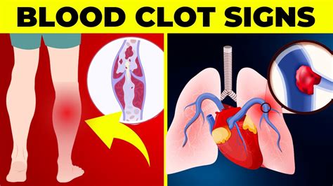 7 Signs Of A Blood Clot You Should Never Ignore Youtube