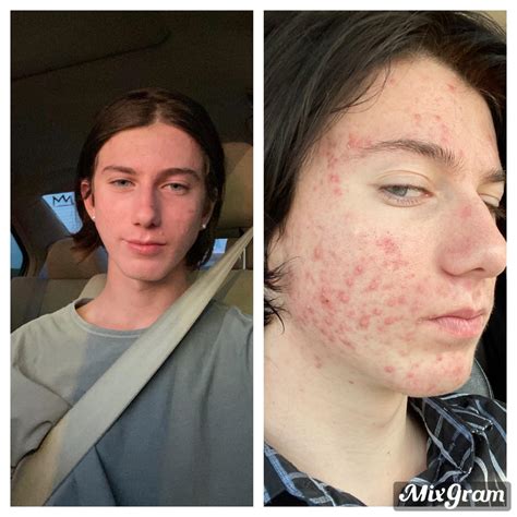 4 Months On Accutane Before And After Racne