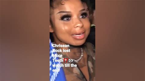 Chrisean Rock Lost More Teeth😨👀 Watch Till The End Chriseanrock