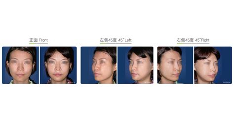 Cheekbone Combined Jaw Reduction Facial Bone Wishclinic