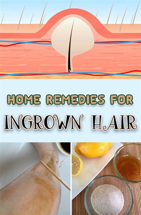 17home Remedies For Ingrown Hair Ingrown Hair Ingrown Hair Remedies