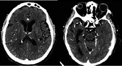 A 1 Month Post Contrast Cerebral Axial Computed Tomography Scan Showing