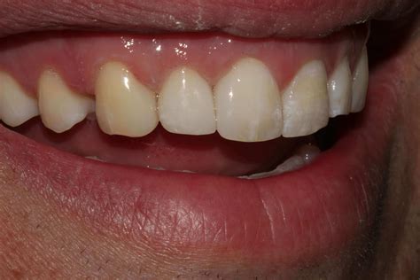 Before and After Dental Bonding & Tooth-Colored Fillings Photos