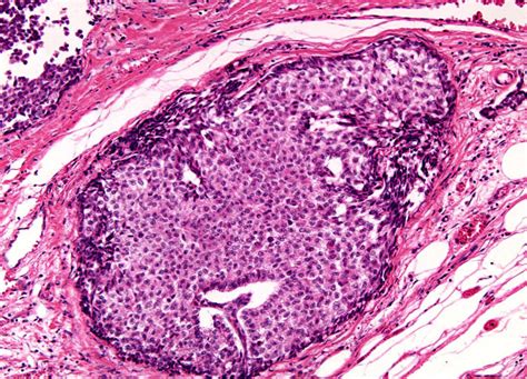 Lymph Node Metastatic Carcinoma At 10x Magnification Nikons Microscopyu