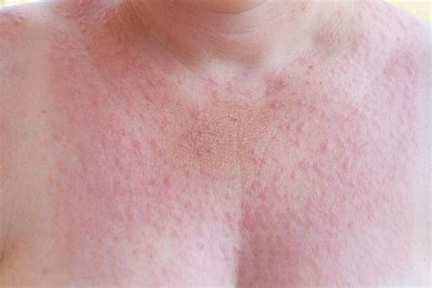 Sun Allergy Rash Symptoms Diseases Skin Protection