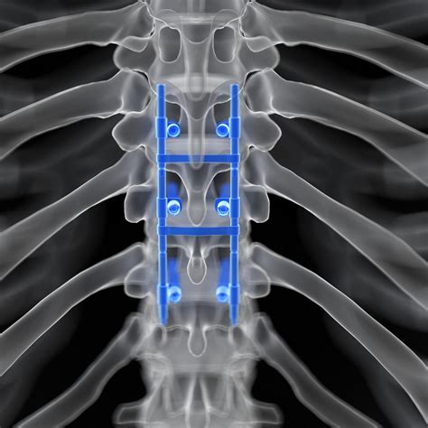 Benefits Of Spinal Fusion New Jersey Comprehensive Spine Care