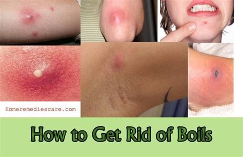 Home Remedies To Get Rid Of Boil Get Rid Of Boils Home Remedy For