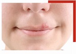 Herpes Simplex - Sutton Dermatology + Aesthetics Ctr