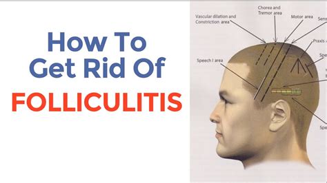 How To Cure Folliculitis And Decrease Excessive Hair Loss Youtube