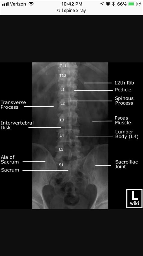 Ap Lumbar Spine Xray Radiology Student Basic Anatomy And Physiology