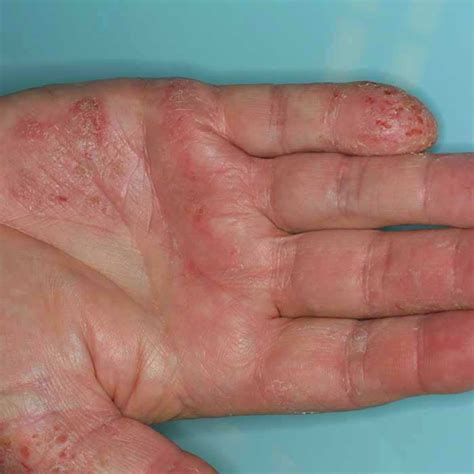 Dyshidrotic Eczema On The Hands Most Skincare