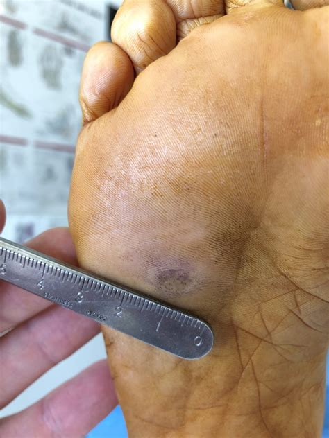 Plantar Warts Getting Rid Of Foot Warts For Good Before And After