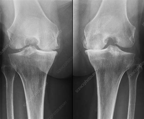 Knees In Osteoarthritis X Ray Stock Image C0517950 Science