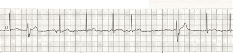 Float Nurse: EKG Rhythm Strips 26: Ectopic beats