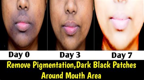 Remove Pigmentationdark Patches Around Mouth100 Result In 3 Usesk